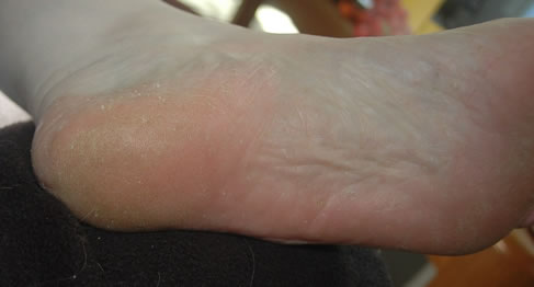 hongo de los pies